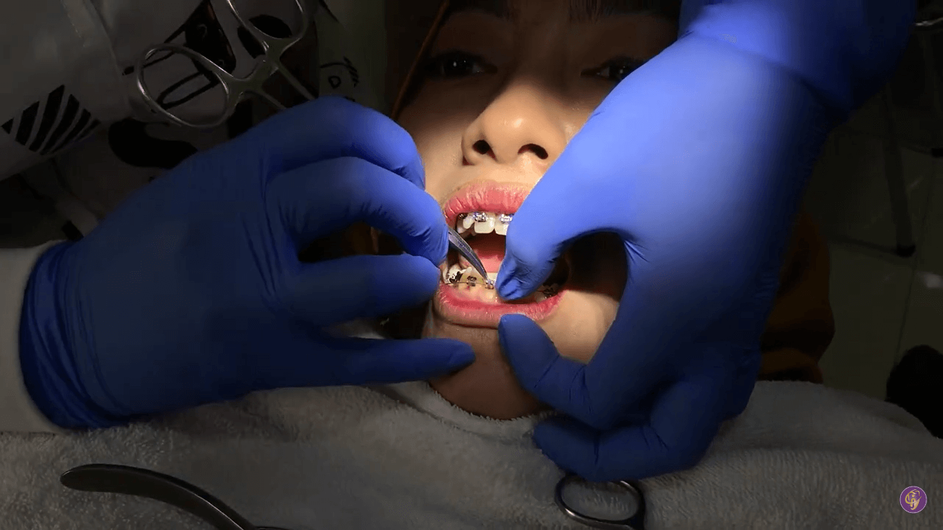Proses pemasangan behel gigi di joy dental