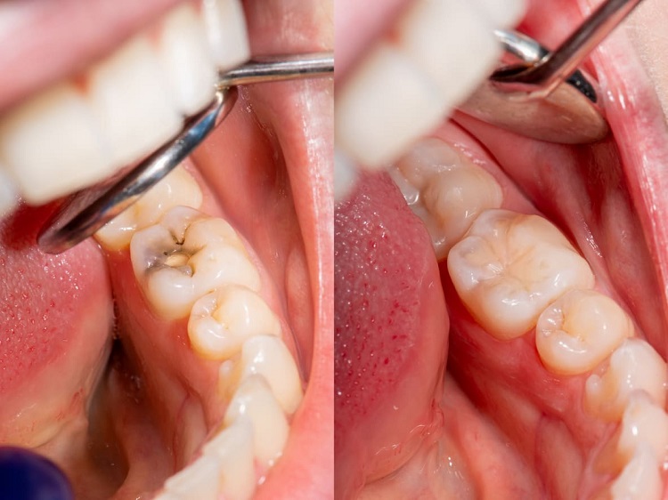 Proses tumbuh gigi bungsu, Sumber: honestdocs.id