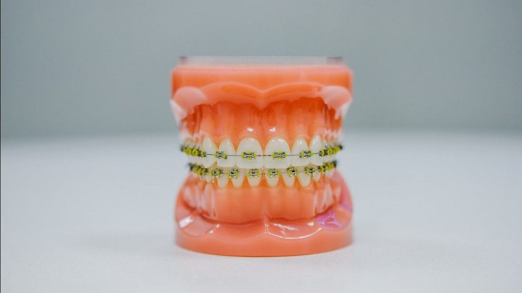 Ilustrasi gigi yang menggunakan behel, Sumber: era.id