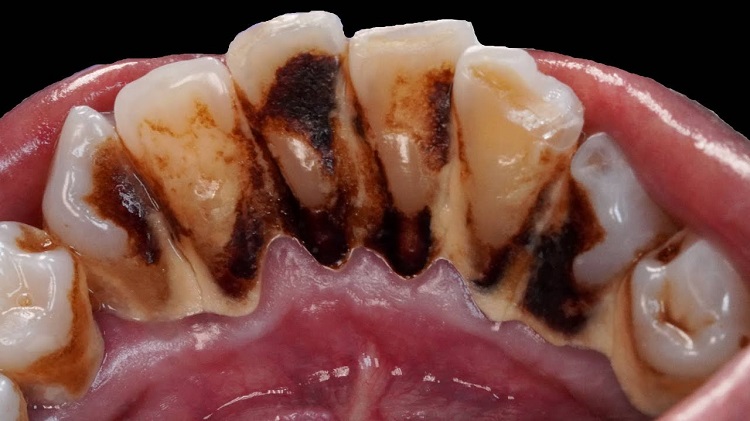 Ilustrasi karang gigi pada perokok berat, Sumber: YouTube