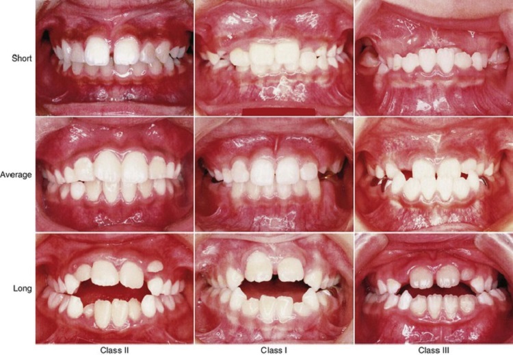 Informasi terkait maloklusi gigi yang wajib diketahui, Sumber: herminahospitals.com