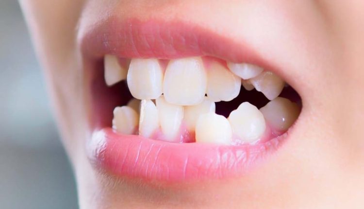 Melakukan pengecekan terhadap gigi anak yang dicurigai maloklusi, Sumber: bernas.id