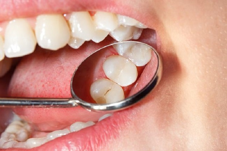 Pemeriksaan gigi secara rutin untuk mendeteksi masalah lubang di gigi, Sumber: alodokter.com