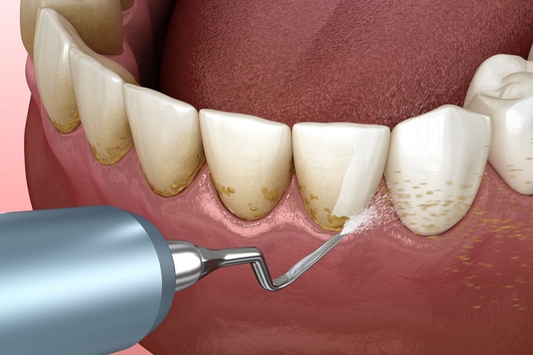 Scaling gigi untuk menghilangkan plak dan karang gigi, Sumber: dentalsolutionsny.com
