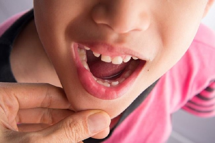Informasi mengenai gigi anak belum goyang tapi sudah tumbuh gigi baru, Sumber: alodokter.com