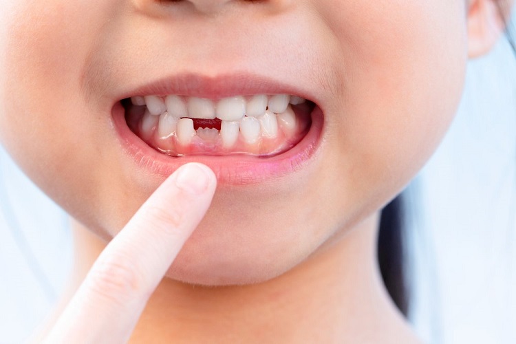 Periode pertumbuhan gigi pada anak, Sumber: parentalk.id