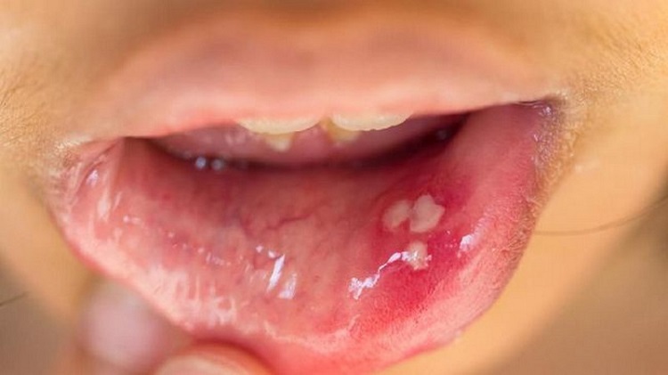 Sariawan yang tidak kunjung sembuh bisa menjadi ciri kanker rongga mulut, Sumber: alinea.id