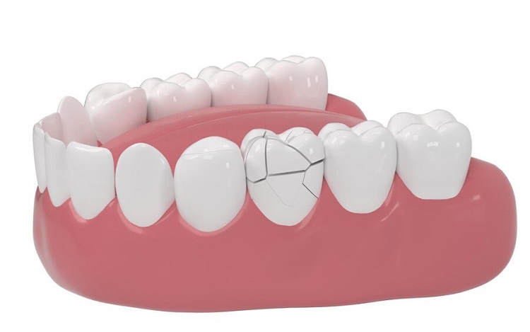 Cara mengatasi gigi retak atau patah, Sumber: ai-care.id