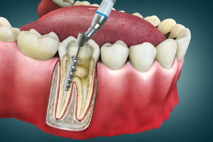 Ilustrasi perawatan saluran akar gigi, Sumber: platinumdentalgroup.com
