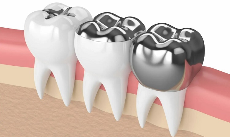 Informasi tentang tambal gigi logam, Sumber: nwnaturaldentistry.com