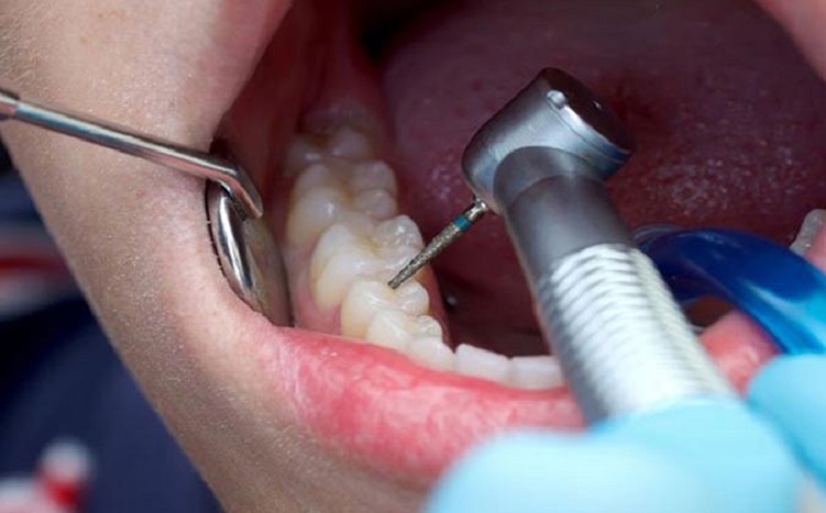 Perawatan saluran akar dilakukan oleh dokter gigi spesialis, Sumber: womenwork.org