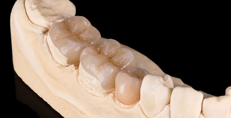 Restorasi dengan inlay and onlay, Sumber: dentistryofsouthflorida.com