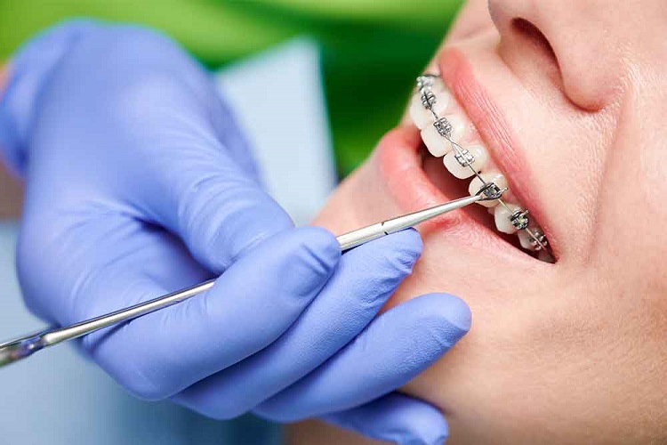 Menggunakan behel untuk mengatasi gigi besar di depan, Sumber: milnororthodontics.com