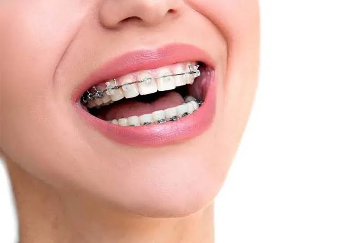 perbedaan behel dan aligner