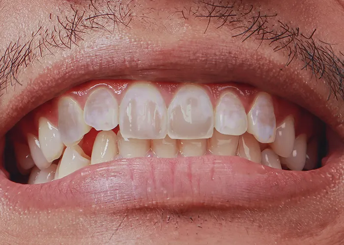 Apa itu fluorosis gigi