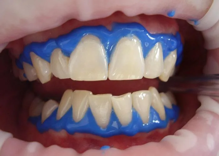 how to whiten teeth
