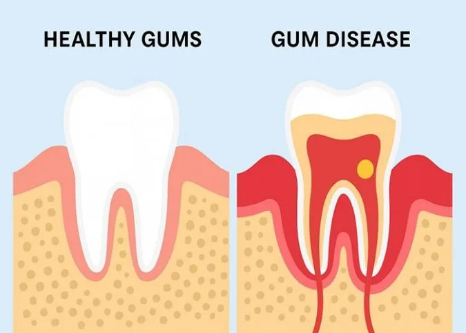 signs of periodontal disease