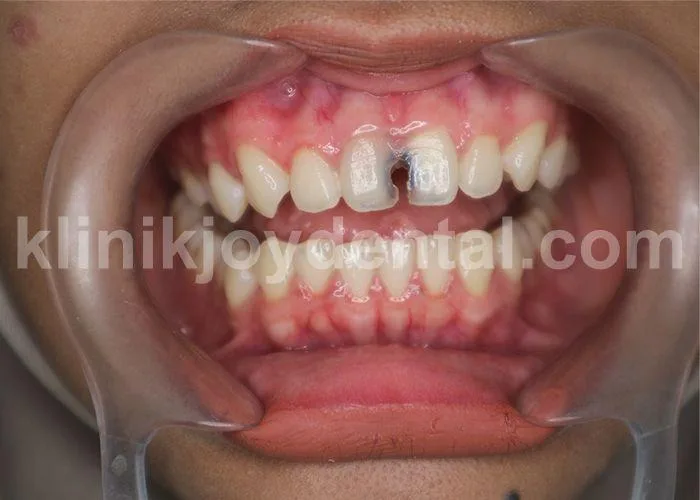 how to prevent tooth decay